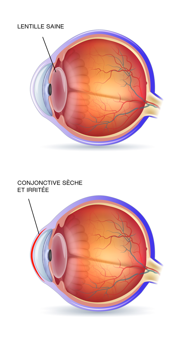 HV-Dry-eye-diagram-FR