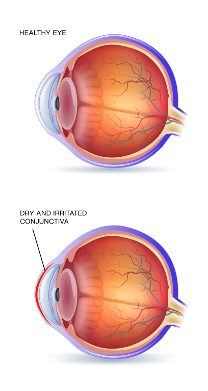 HV-Dry-eye-diagram