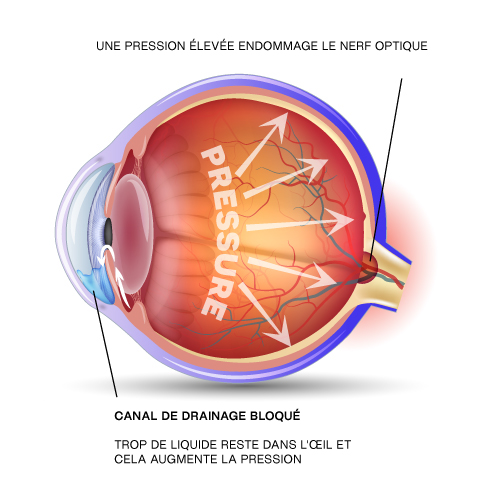 HV-GLAUCOMA-diagram-FR