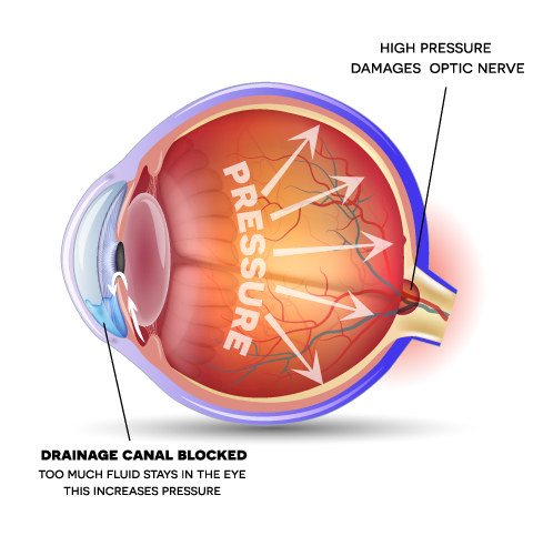HV-GLAUCOMA-diagram