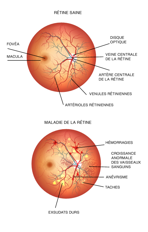 HV-retinal-disease-FR