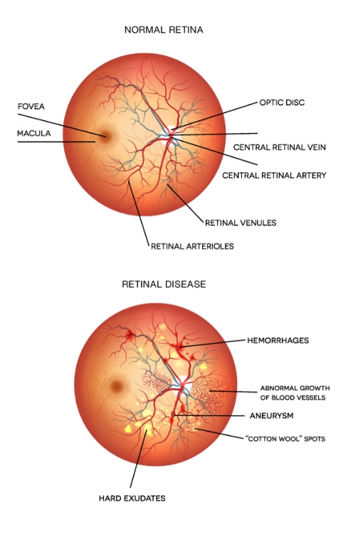 HV-retinal-disease