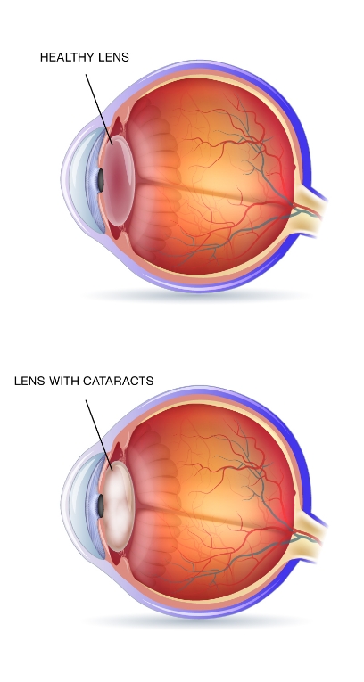 What is a cataract