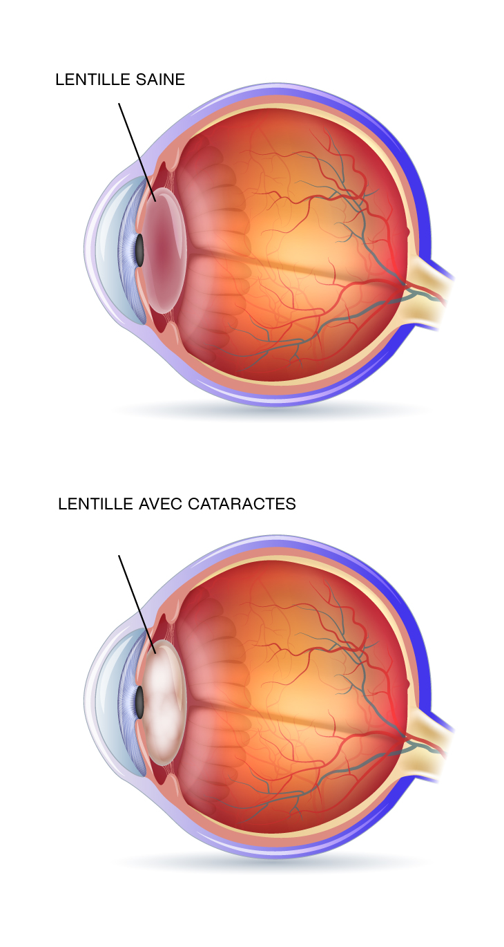 diagram-yeux-CATARACT-FR